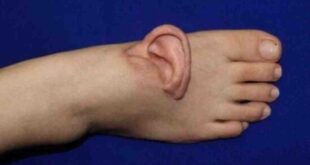 ahli bedah china pindahkan telinga wanita ke kaki selama 5 bulan index