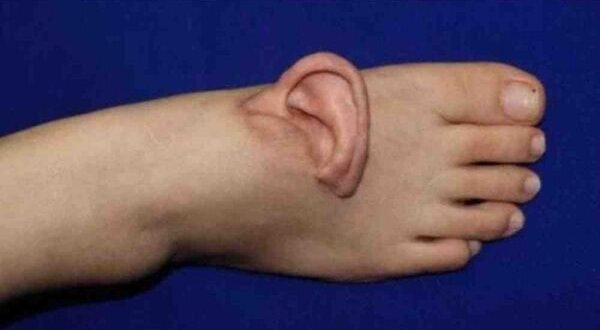 ahli bedah china pindahkan telinga wanita ke kaki selama 5 bulan index