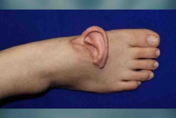 ahli bedah china pindahkan telinga wanita ke kaki selama 5 bulan index